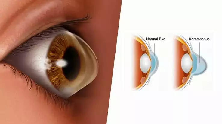 What is the Cause of Keratoconus?