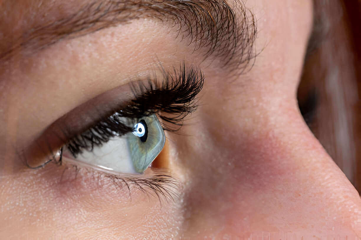 What Should You Avoid if You Have Keratoconus?