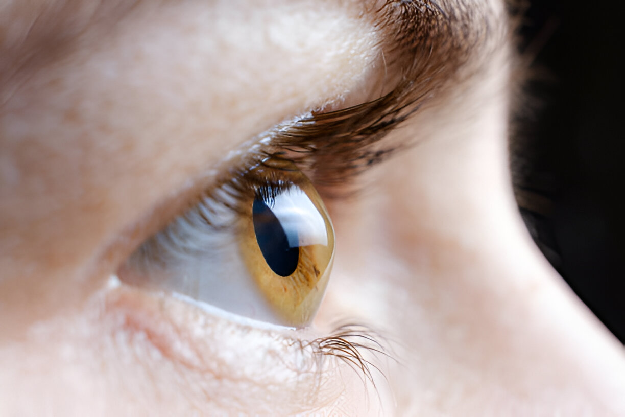 What Happens If Keratoconus Is Left Untreated?