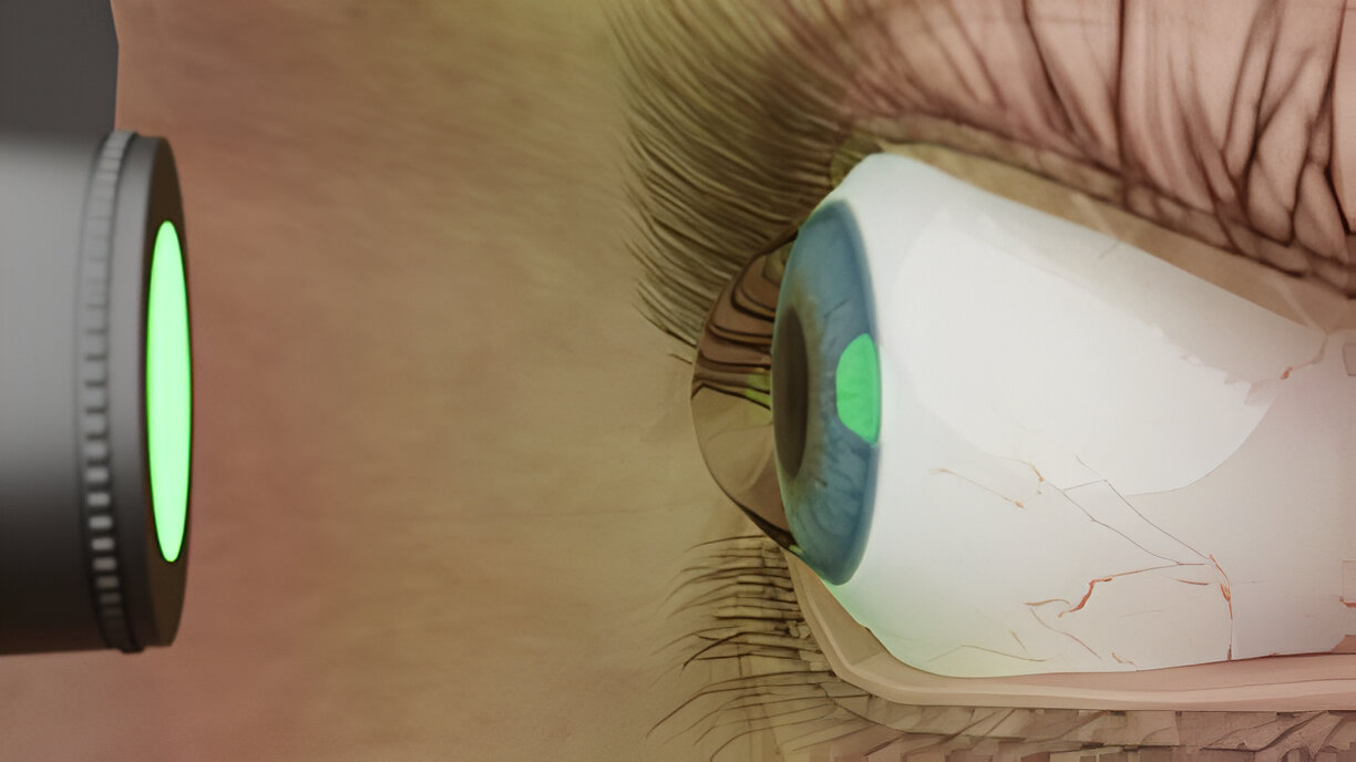 How Successful Is Keratoconus Surgery?