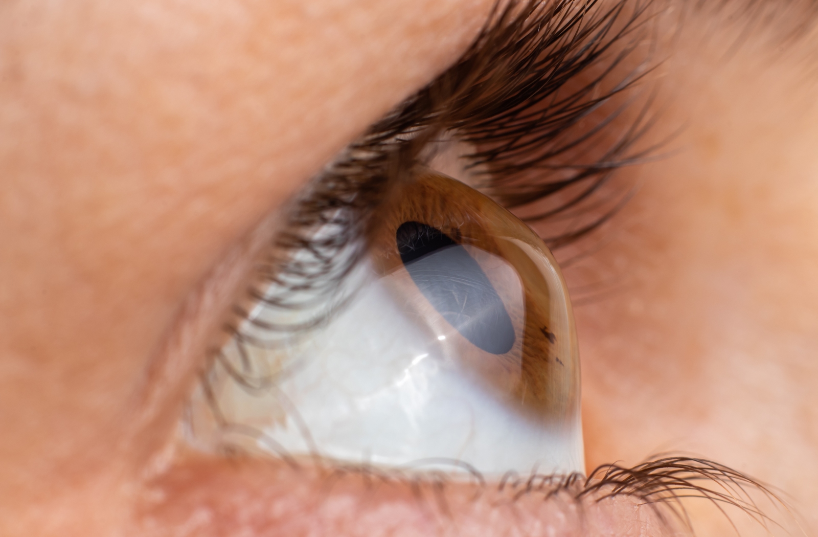 Best Treatment for Keratoconus