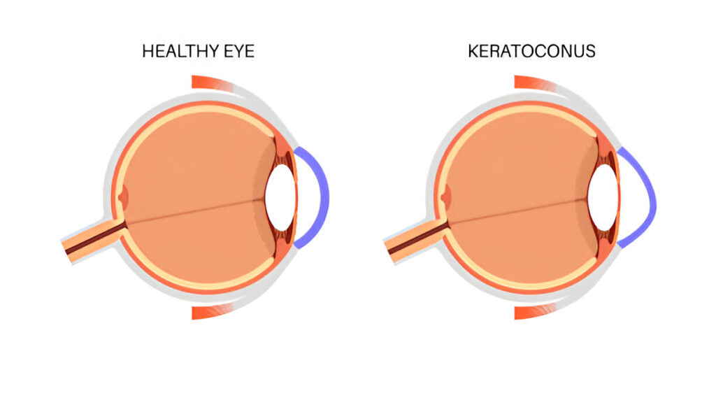 Is Keratoconus a Disability?